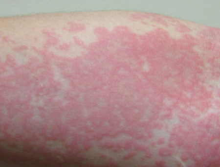 Symptoms of Covid : Coronavirus: Skin rash can be just COVID-19 manifestation and ought to be fourth key sign, study finds